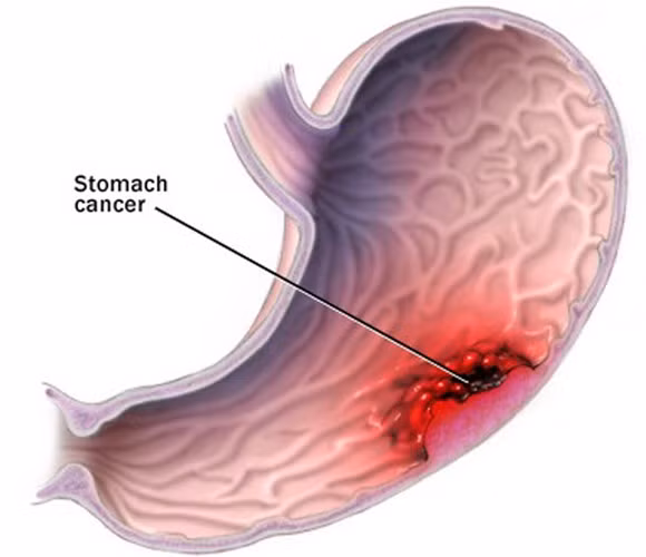 Ung thư dạ dày: Đây là loại ung thư phổ biến thứ tư trên thế giới với 930.000 trường hợp mắc phải vào năm 2002 và là nguyên nhân thứ hai gây tử vong sau ung thư phổi với khoảng 800.000 ca tử vong trên toàn thế giới mỗi năm.