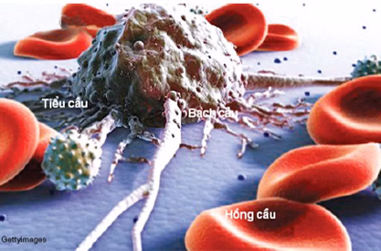 Ung thư bạch cầu: Là sự tăng trưởng bất thường của tế bào máu trắng. Hiện nguyên nhân của căn bệnh này vẫn chưa được xác định chính xác. Nó có thể gặp phải ở bất kỳ nhóm tuổi nào, tuy nhiên, 90% bệnh ung thư bạch cầu được phát hiện ở người lớn. Trong năm 2010, có khoảng 281.500 người đã tử vong trên toàn cầu vì bệnh này.