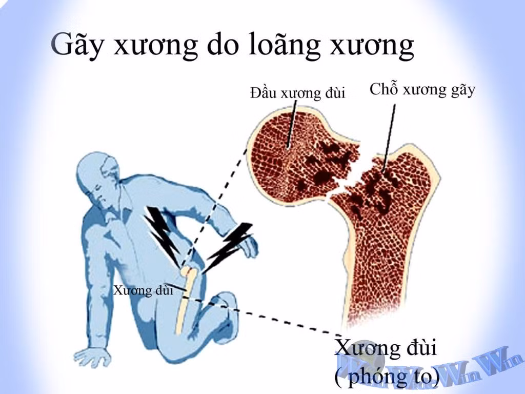Nếu xét nghiệm rất khó biết được là có bị thiếu Ca hay không vì khi Ca trong đường huyết bị giảm xuống khi đó cảm thấy hoa mắt chóng mặt, cảm giác đó chỉ diễn ra trong vài chục giây rồi lại trở lại trạng thái bình thường.