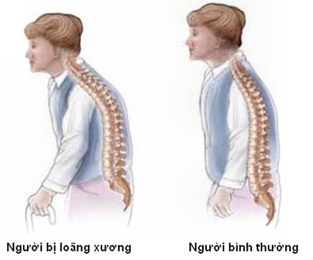 Chóng mặt: Ngồi lâu một chỗ cảm thấy tay chân bị tê, mỏi lưng, khi đứng dậy bị hoa mắt chóng mặt.
