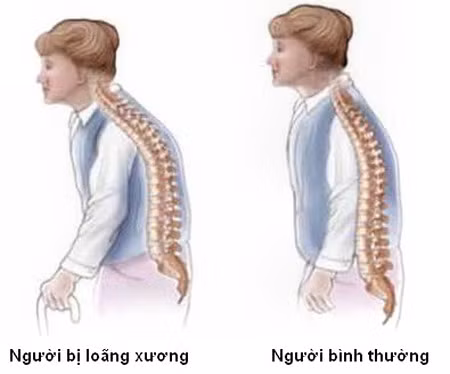 Chóng mặt: Ngồi lâu một chỗ cảm thấy tay chân bị tê, mỏi lưng, khi đứng dậy bị hoa mắt chóng mặt.