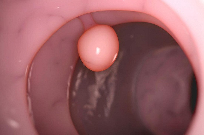 Polyp dạ dày. Polyp dạ dày là khối tế bào hình thành trên niêm mạc dạ dày. Polyp dạ dày khá đa dạng bao gồm u tuyến, polyp tăng sản và polyp viêm. Đa số các khối polyp là lành tính song một số polyp có khả năng chuyển ác tính nếu không được điều trị kịp thời.