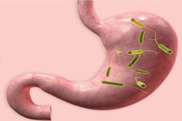Người nhiễm khuẩn H.P. Vi khuẩn H.P (Helicobacter pylori) sống trong dạ dày, dưới lớp nhầy niêm mạc dạ dày, sát cạnh các tế bào biểu mô, không xâm nhập các mô.