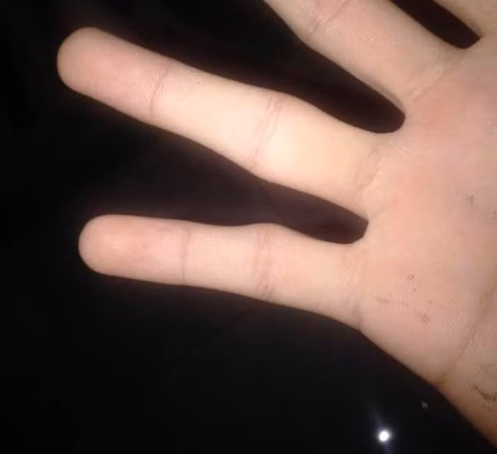 Biến dạng ngón út. Biến dạng ngón út còn được biết đến với tên gọi “smartphone pinky”. Khi đó, ngón út của bạn có xu hướng hơi cong do thường xuyên phải nâng đỡ điện thoại.