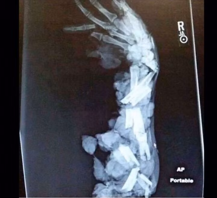 Khi xem bức ảnh này, nhiều người cảm thấy xót xa, đau đớn khi bị gãy xương nghiêm trọng.