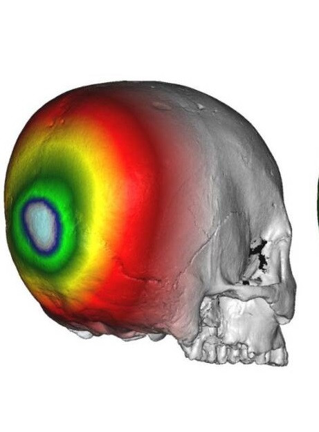 Tuy nhiên, đến nay, giới nghiên cứu chưa thể giải mã lý do người Hirota làm biến dạng hộp sọ của trẻ sơ sinh.