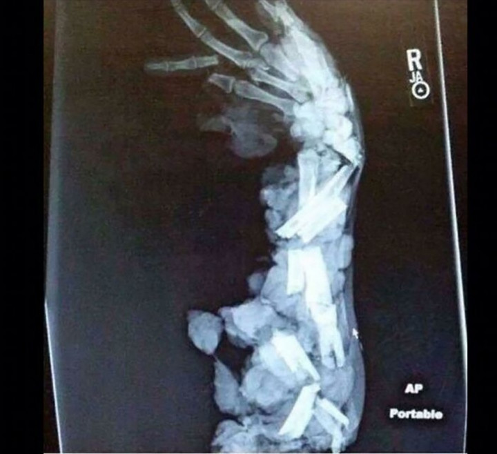 Khi xem bức ảnh này, nhiều người cảm thấy xót xa, đau đớn khi bị gãy xương nghiêm trọng.