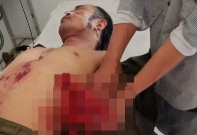  Chế mìn đánh cá gây nổ khiến 7 người bị thương: Ngày 2/3, UBND xã Đạ Tông (huyện Đam Rông, Lâm Đồng) cho biết, trưa 28/2, khi nhóm người đang tổ chức ăn uống tại xã Đạ Tông thì một người mang thuốc nổ ra bỏ vào trong vỏ lon để chế tạo mìn với mục đích đi đánh cá. Trong lúc anh Ntơr Ha Sôl (SN 1985) đang nhồi thuốc nổ trong lon thì bất ngờ phát nổ. Hậu quả, anh Ntơr Ha Sôl bị thương nặng, dập nát hoàn toàn bàn tay trái và 6 người khác bị thương trong đó có 3 trẻ em. 