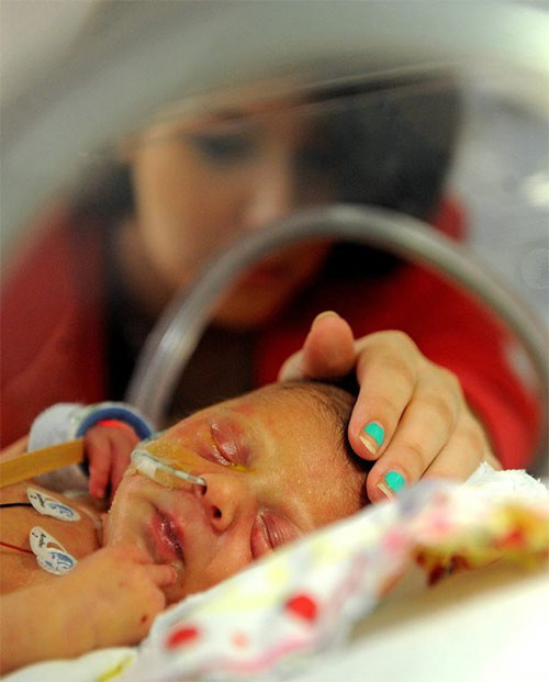 Bé gái sơ sinh Sienna Alfonso đến từ Hunts Cross, Merseyside mang dị tật bẩm sinh ra đời với trái tim chỉ có một nửa. Nhưng em vẫn may mắn sống sót, sự sống của em hoàn toàn phụ thuộc vào máy thở và sự chăm sóc đặc biệt của các y bác sĩ. Nếu có cơ hội sống sót, Sienna sẽ cần một ca phẫu thuật khác khi 5 tháng tuổi và khi 4 tuổi cô bé cũng phải làm phẫu thuật. Khi lớn hơn cô bé sẽ được cấy ghép tim.