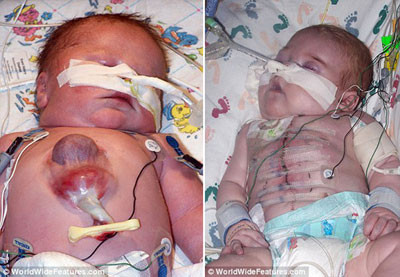 Bé Ryan Marquiss mắc phải chứng bệnh có tên khoa học Ectopia cordis với phần tim lồi ra khỏi cơ thể và chỉ được che chắn bởi một lớp màng mỏng. Tỷ lệ mắc phải chứng bệnh này trên thế giới chỉ là 8/8.000.000 người. 90% trường hợp mắc bệnh này đều chết ngay sau khi sinh hoặc chỉ sống thêm được khoảng 3 ngày. Trái tim của Ryan thậm chí không phát triển đầy đủ, em phải sống với một nửa quả tim bên trái. Đây là trường hợp bệnh nhi đầu tiên trên thế giới mắc phải hai chứng bệnh hiếm gặp cùng một lúc.