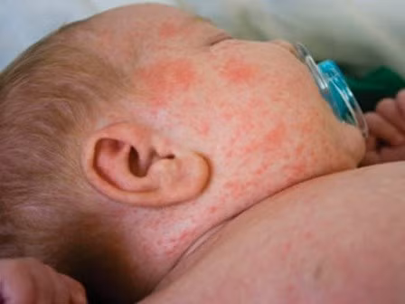 5. Bệnh sởi. Sởi là bệnh theo mùa, thường gặp ở trẻ em và là bệnh lành tính. Bệnh thường gặp nhất vào cuối đông và mùa xuân vì thời điểm này độ ẩm tăng cao, không khí ẩm mốc, vi khuẩn dễ sinh sôi nảy nở. Sởi là bệnh rất dễ điều trị, có thể tự khỏi nhưng nếu không chăm sóc đúng cách có thể dẫn đến tử vong ở những trẻ dưới 5 tuổi. Những trẻ có nguy cơ mắc bệnh cao là những trẻ có thể trạng yếu, sinh non, không được tiêm phòng ngừa vắc xin đầy đủ.