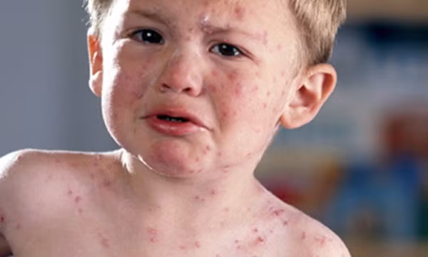 3. Ngoài ra, nồm ẩm còn dễ khiến cơ thể mắc các bệnh sốt phát ban, thuỷ đậu, rubella ở trẻ nhỏ. Do đó, khi thấy trẻ ho, sốt... cần đưa đi khám sớm để tránh bệnh chuyển nặng. Nên đưa trẻ nhỏ đi tiêm phòng các loại vaccine phòng bệnh. Nếu trẻ ốm nên cho trẻ nghỉ học, vừa để chăm sóc vừa để tránh lây lan trong nhà trẻ, trường học.