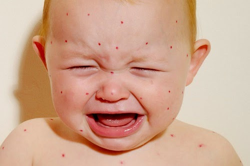 4. Thủy đậu. Thủy đậu là một căn bệnh nguy hiểm do virus Varicella Zoster gây nên với biểu hiện là các nốt tròn nhỏ khắp cơ thể, gây ngứa, sau đó chuyển thành mụn nước và khô đi sau 5 – 7 ngày. Căn bệnh này rất dễ lây nhiễm, nhất là trong điều kiện thời tiết nồm, ẩm ướt, khi chúng ta tiếp xúc với nguồn bệnh, kể cả qua đường hô hấp.