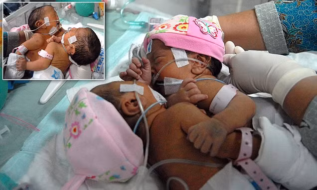 Bệnh viện Soetomo, nơi 2 bé đang được chăm sóc, từng thực hiện 53 ca phẫu thuật tách các cặp song sinh dính liền trong quá khứ. Trong đó chỉ có 2 ca phẫu thuật thất bại bởi tim bất thường khi sinh ra.