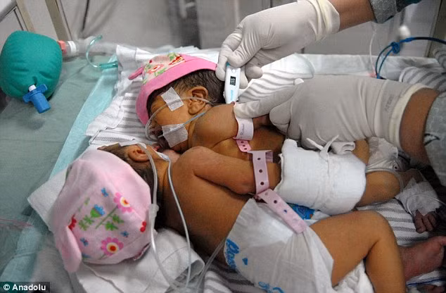 Hội chứng chung trái tim bẩm sinh này khiến cho 2 em lâm vào tình cảm "không thể tách rời".