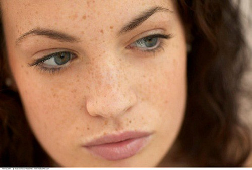 Cân nhắc khi thực hiện các phương pháp điều trị. Hầu hết các phương pháp điều trị nám đều không an toàn khi mang thai hoặc cho con bú. Một số thành phần như axit azelaic có trong các loại kem bôi được coi là an toàn nhưng vẫn có những rủi ro nhất định, bạn buộc phải tham khảo ý kiến bác sĩ.