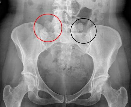 4. Đau xương chậu mãn tính. Nếu không điều trị chlamydia có thể dẫn đến đau xương chậu mãn tính ở phụ nữ.