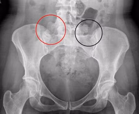 4. Đau xương chậu mãn tính. Nếu không điều trị chlamydia có thể dẫn đến đau xương chậu mãn tính ở phụ nữ.