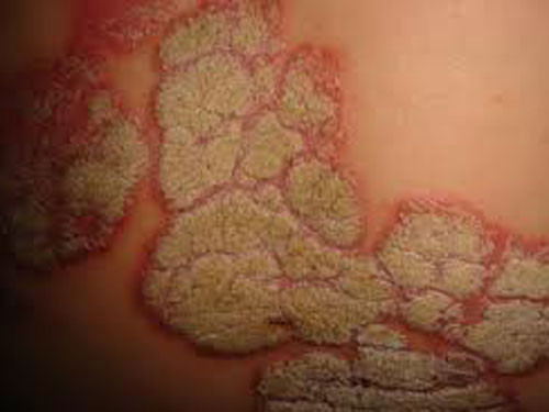 2. Các bệnh hoa liễu. Những người có chlamydia cũng có thể có nguy cơ nhiễm trùng qua đường tình dục khác, chẳng hạn như bệnh lậu, giang mai và viêm gan. Bác sĩ có thể khuyên nên thử nghiệm về lây nhiễm khác qua đường tình dục nếu có chlamydia.