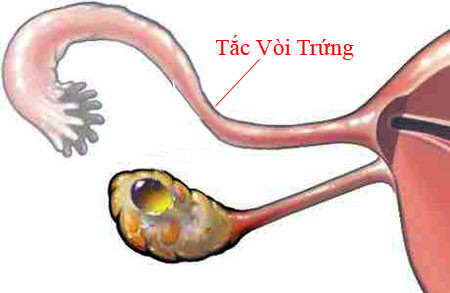 5. Vô sinh. Sẹo ở ống dẫn trứng( có thể dẫn đến tắc vòi trứng), gây ra bởi nhiễm chlamydia có thể dẫn đến vô sinh.