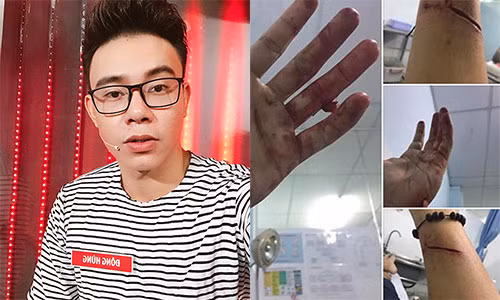 Ca si Dong Hung bi chem rach tay boi chu no cua me?