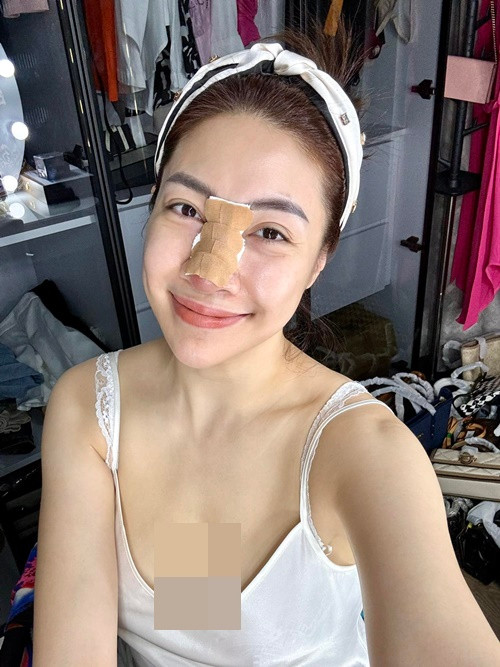 Pha Lê tháo sụn mũi cũ và làm sạch ổ viêm ở bệnh viện. Ảnh: FBNV.