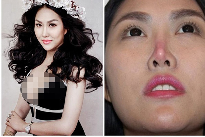 Đầu năm 2015, sau 11 năm đặt silicon sống mũi, Phi Thanh Vân bị biến chứng. Mũi của cô bị teo, lệch sang một phía, đầu mũi bị sưng tấy, có dấu hiệu hoại tử. Ảnh: Vietnamnet.