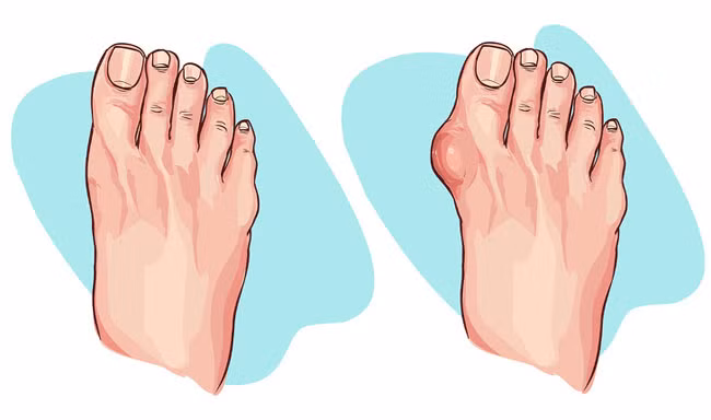 3 bộ phận cơ thể "lâm nguy" khi bạn đi giày cao gót quá nhiều - Hình 4 3 bo phan co the