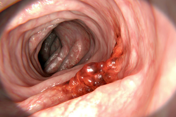 Nguoi dan ong dot tu sau 2 tuan do bo qua dau hieu ung thu nay-Hinh-3