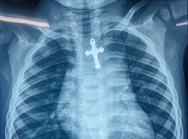 Be trai 3 tuoi nguy kich vi nuot cay thanh gia vao thuc quan