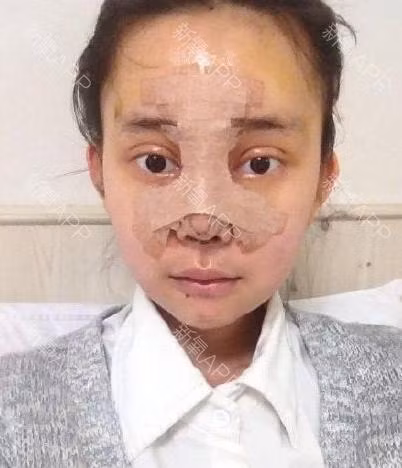 co nang vit hoa thien nga nho phau thuat-Hinh-5