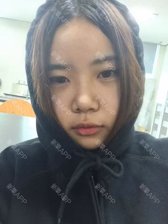 Sau 7 ngày, mặt cô đã bớt sưng hơn nhưng vẫn cần đến bệnh viện để kiểm tra.