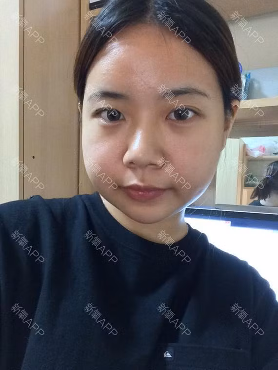 Một tháng sau khi phẫu thuật, mặt cô có vẻ đỡ hơn một chút.