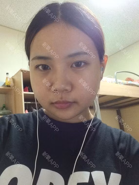 15 ngày sau phẫu thuật, mặt cô lại bắt đầu sưng phồng trở lại. Tuy nhiên, cô cho biết đây chỉ là một hiện tượng bình thường.