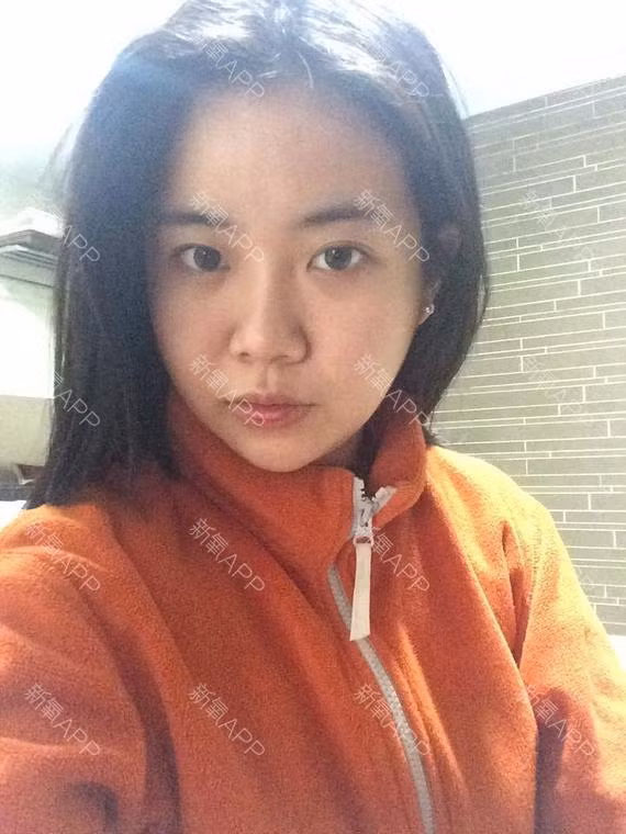 45 ngày sau khi phẫu thuật thẩm mỹ, cằm của cô đã thon gọn hơn sau khi má bớt sưng. Giờ đây, khuôn mặt của cô đã bắt đầu hình thành V-line.