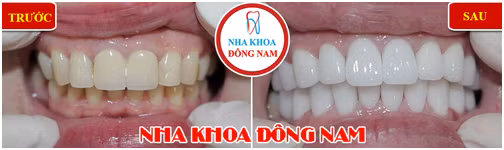 Trong rang gia co dinh voi gia uu dai tai Nha Khoa Dong Nam-Hinh-3