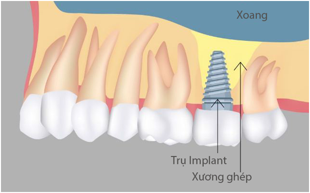 Tieu xuong ham khong con can tro viec trong rang gia