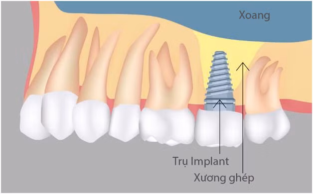 Tieu xuong ham khong con can tro viec trong rang gia