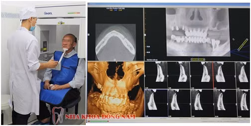 Tieu xuong ham khong con can tro viec trong rang gia-Hinh-4