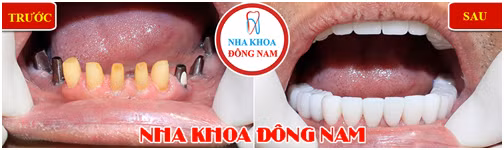 Tieu xuong ham khong con can tro viec trong rang gia-Hinh-5
