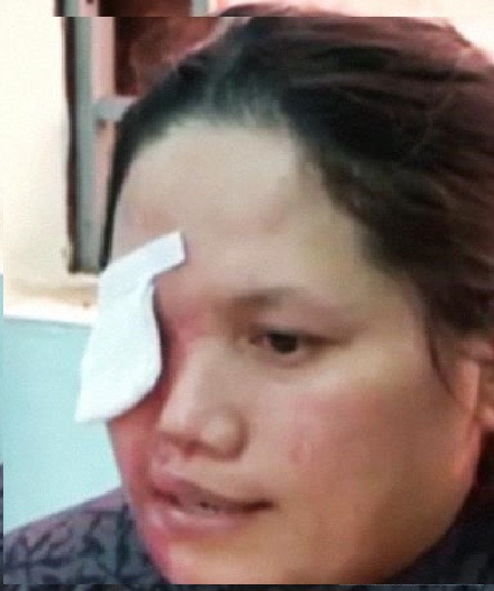 Nạn nhân Phương bị hỏng một bên mắt.