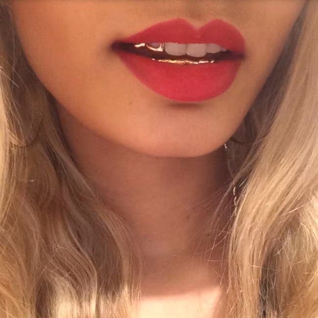 Răng sứ bọc vàng là trào lưu của Hội con nhà giàu Dubai.