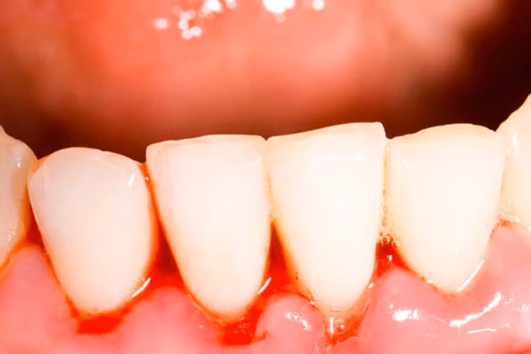 Chảy máu: Đây cũng là một trong những tác dụng phụ hàng đầu của việc sử dụng aspirin và cũng là một trong những tác dụng phụ nguy hiểm nhất. Một số dấu hiệu và triệu chứng bao gồm chảy máu mũi, chảy máu do vết thương, vết cắt, vết thâm tím ... rất khó lành.