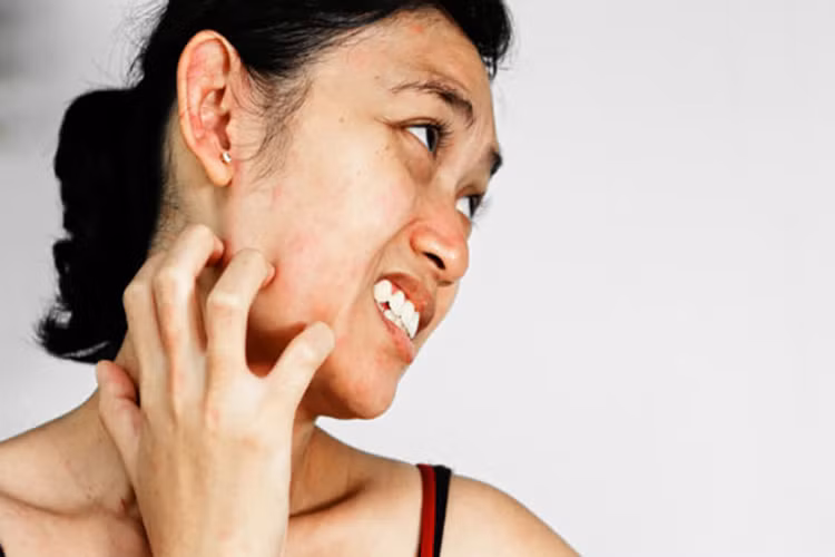 Phản ứng phụ dị ứng: Một trong những tác dụng phụ của aspirin là dị ứng. Các triệu chứng bao gồm sưng lưỡi, môi và mặt, ngứa đột ngột, phát ban da, thở khò khè, hen suyễn, thở dốc,...