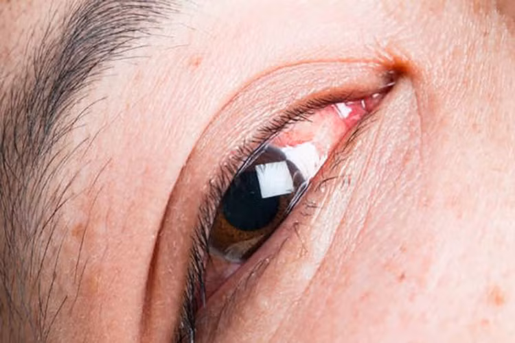 Một số tác dụng phụ khác của aspirin bao gồm viêm kết mạc, viêm mũi, co thắt phế quản, nổi mề đay và phù mạch.