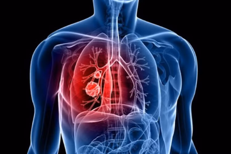 Các vấn đề hô hấp: Một số vấn đề hô hấp có thể phát sinh là thở nhanh và phù phổi. Điều này cũng được khẳng định trong nghiên cứu "Quá mẫn cảm với aspirin ở những bệnh nhân viêm đa khớp tủy và viêm đa xoang mũi: Liều lượng và các yếu tố góp phần".