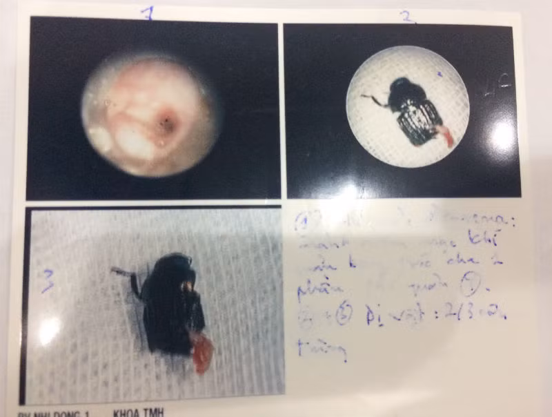 Be 8 thang tuoi suyt chet vi xu tri sai cach cua me