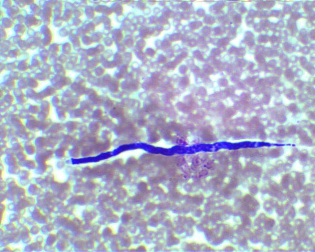 Loa loa là một trong ba loài giun tròn ký sinh trùng gây ra bệnh giun chỉ dưới da ở người. Loài ký sinh trùng xâm nhập vào cơ thể con người thông qua vết cắn của một con ruồi. Nạn nhân trải qua các triệu chứng có thể từ ngứa và đau khớp mệt mỏi đến tử vong.