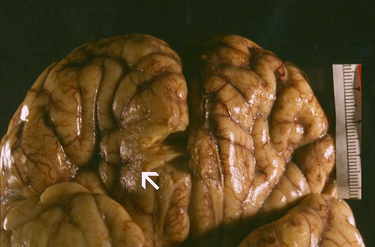 Khi xâm nhập vào cơ thể người, loại amip Naegleria fowleri sẽ sinh sôi, phát triển rất nhanh, sau đó di chuyển lên não người. Từ đây nó sẽ bắt đầu ăn các tế bào thần kinh gây nên chứng đau đầu khủng khiếp, bệnh nhân bị sốt, có ảo giác và thậm chí mất khả năng kiểm soát hành vi.