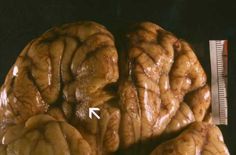 Khi xâm nhập vào cơ thể người, loại amip Naegleria fowleri sẽ sinh sôi, phát triển rất nhanh, sau đó di chuyển lên não người. Từ đây nó sẽ bắt đầu ăn các tế bào thần kinh gây nên chứng đau đầu khủng khiếp, bệnh nhân bị sốt, có ảo giác và thậm chí mất khả năng kiểm soát hành vi.